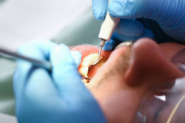 Best Emergency Wisdom Tooth Extraction in Avenel, NJ